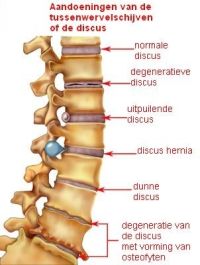 Helpt bij discus hernia, ischias, lumbago